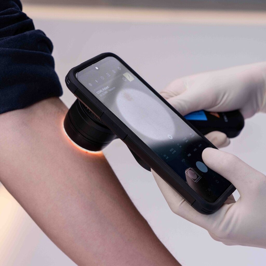 Uso de DICOM Camera con adaptador dermatoscopio para diagnóstico por imagen cutánea.
