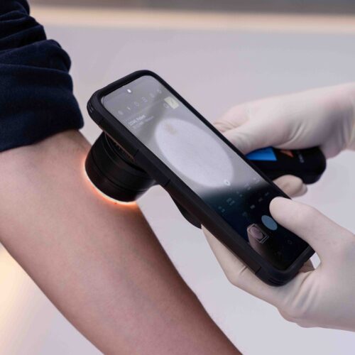 Uso de DICOM Camera con adaptador dermatoscopio para diagnóstico por imagen cutánea.